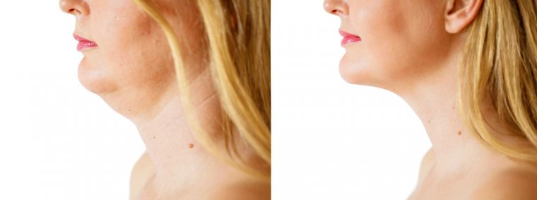 Neck-Liposuction